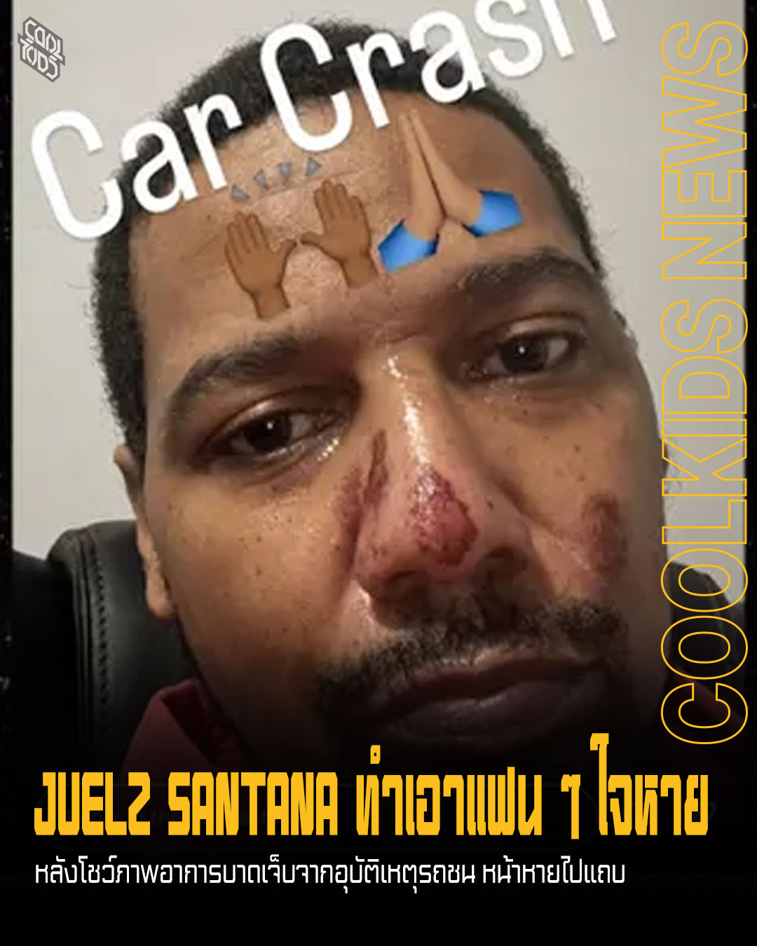 JUELZ SANTANA ทำเอาแฟน ๆ ใจหาย หลังโชว์ภาพอาการบาดเจ็บจากอุบัติเหตุรถชน หน้าหายไปแถบ